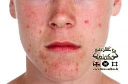 Moderate-acne-on-face استروئیدها و عوارض جانبی آنها قسمت چهارم