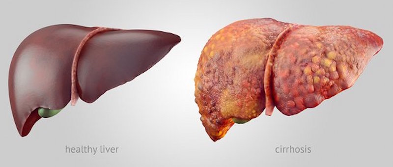 healthy and cirrhosis liver