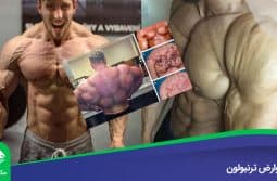 عوارض-ترنبولون عوارض ترنبولون